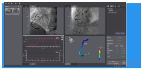 三證齊發(fā),脈流科技心腦血管病功能學(xué)評(píng)估產(chǎn)品獲nmpa認(rèn)證